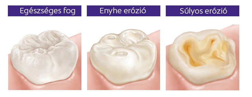 erózió